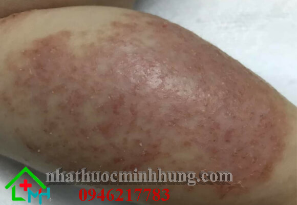Bé bị viêm da cơ địa ở chân