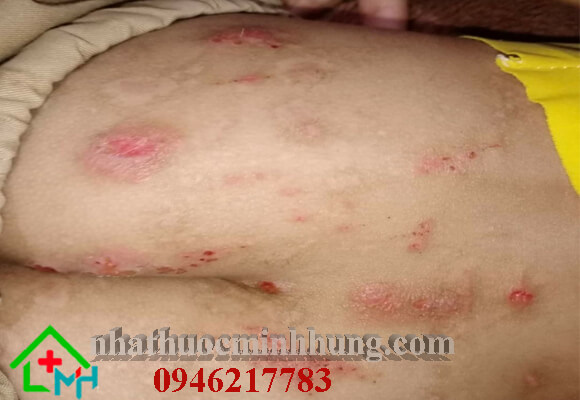 Bé bị viêm da cơ địa ở mông