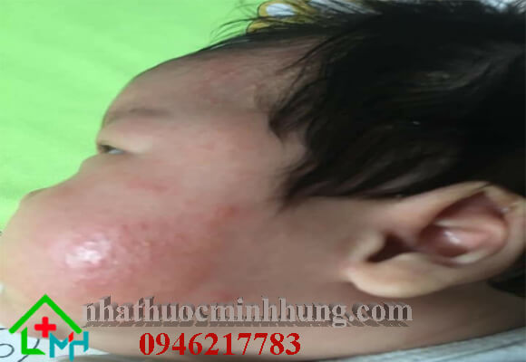 Hình ảnh bé gái bị chàm sữa ở mặt