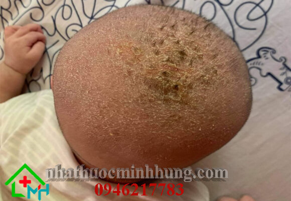 bé bị viêm da đầu đóng vẩy khô ngứa